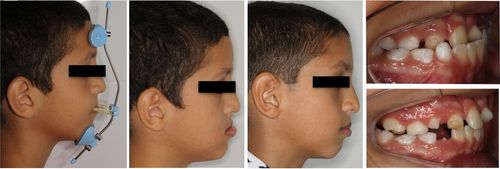 Estudo da UFS mostra que tratamento ortodôntico precoce em crianças com “fissura labiopalatina” pode diminuir necessidade de cirurgia