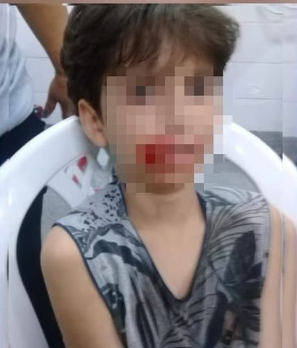 Itabaiana: Criança é atacada por cachorro e recebe 21 pontos na boca